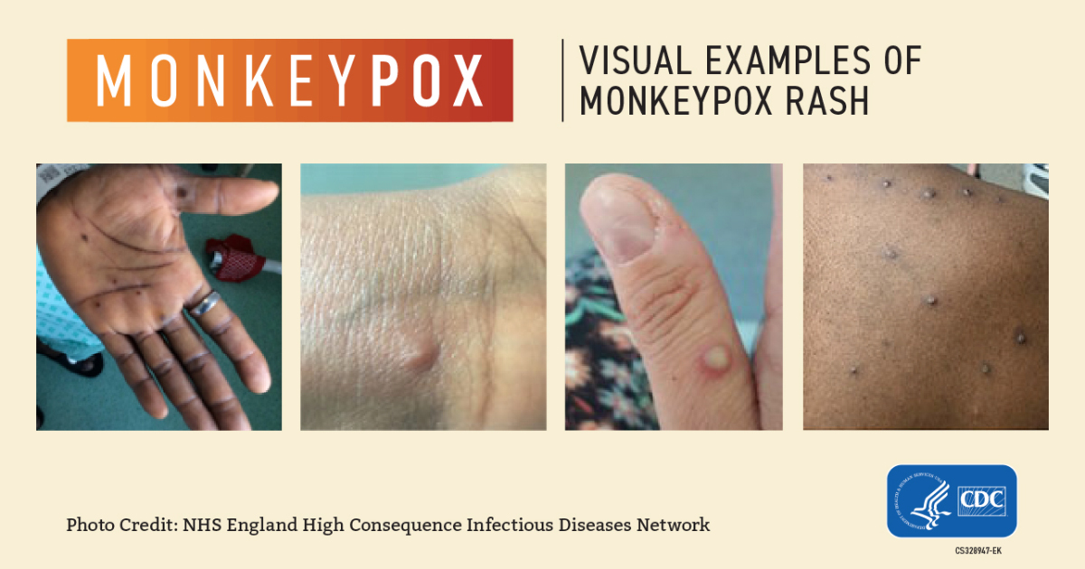 According to the findings of a recent study, monkeypox is not only transmitted through skin contact but also through the exchange of seminal fluid