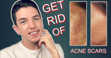 How to get rid of acne scars fast