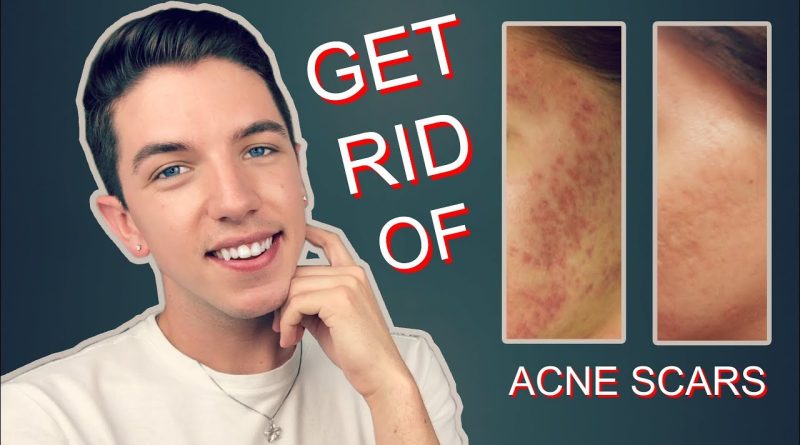 How to get rid of acne scars fast